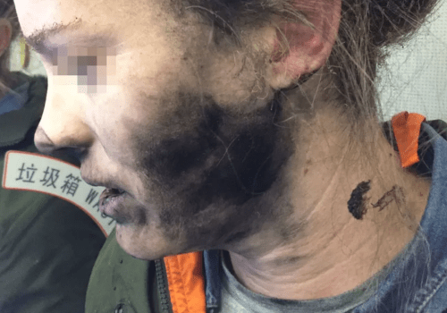 A woman sleeping on an airplane was burned by her exploding headphones